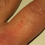 bedbug feeding on finger
